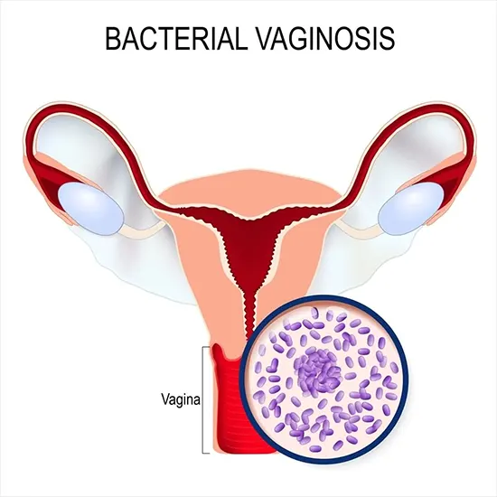 Understanding Bacterial Vaginosis : Causes, Symptoms and Treatment Options